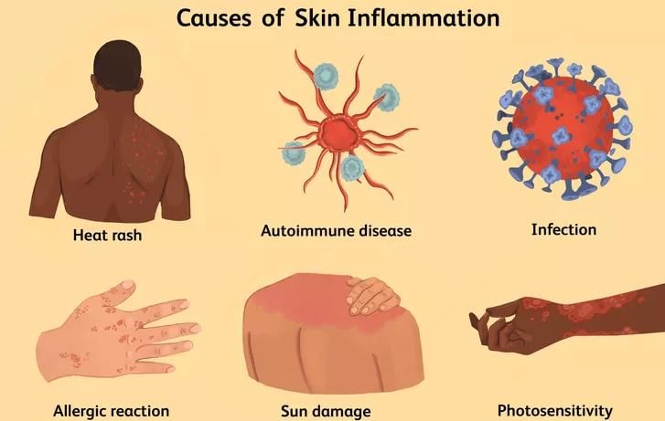 Inflammation Chapter Notes | Pathology - NEET PG