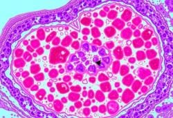 Miscellaneous Topics of Pathology Chapter Notes - Pathology - NEET PG PDF