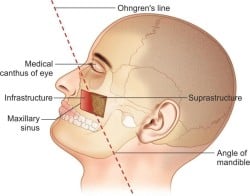 Tumours of Nose and PNS Chapter Notes - Ear Nose Throat (ENT) - NEET PG