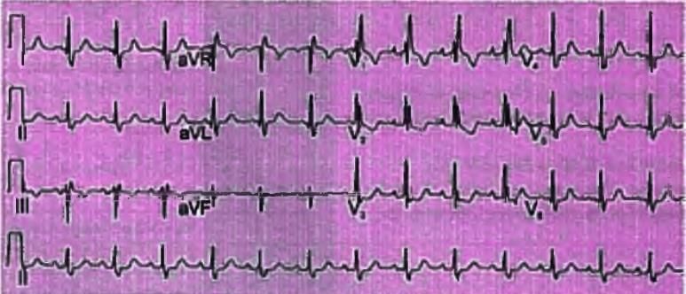 Cardiology Chapter Notes | Medicine - NEET PG