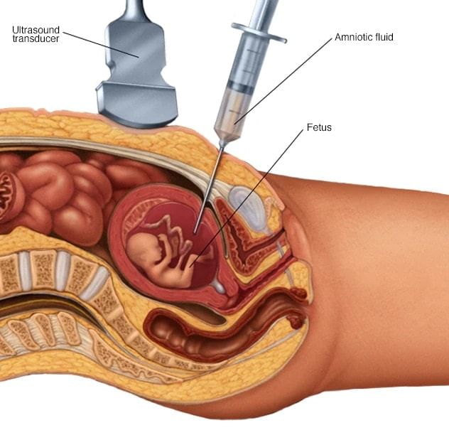 Amniocentesis: Reproductive Health | Additional Study Material for NEET
