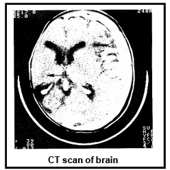 Cancer: Causes, Detection, Diagnosis & Treatment | Additional Study Material for NEET