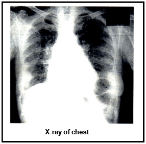 Cancer: Causes, Detection, Diagnosis & Treatment | Additional Study Material for NEET