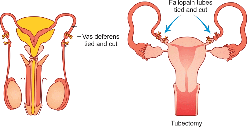 Surgical Contraception