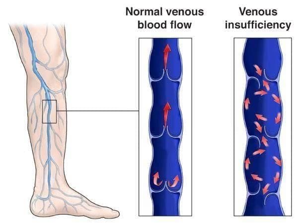What is Chronic Venous Insufficiency (CVI)?