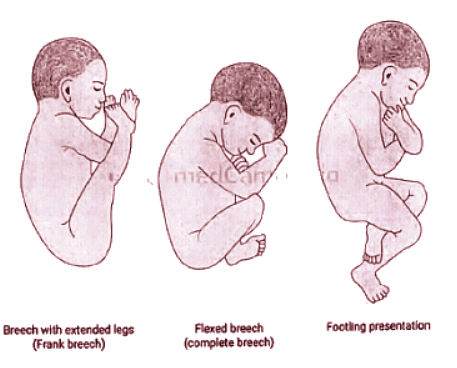 Abnormal Labour | Medical Science Optional Notes for UPSC
