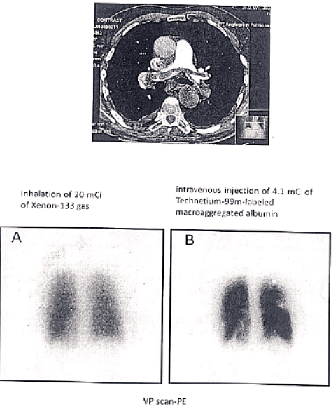 Pulmonary embolism | Medical Science Optional Notes for UPSC