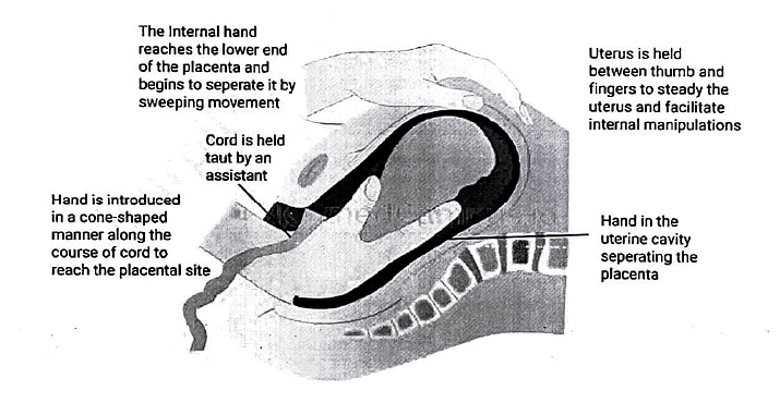 Complications of third stage of Labour | Medical Science Optional Notes for UPSC