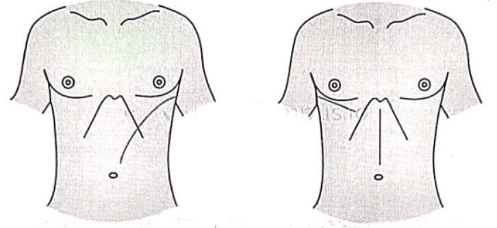 Carcinoma Esophagus | Medical Science Optional Notes for UPSC