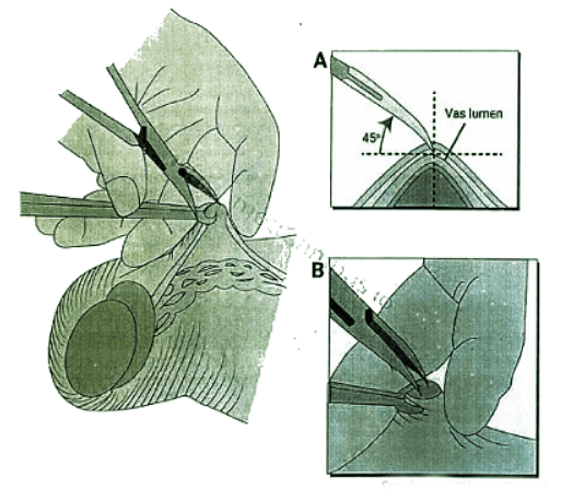 Sterilization | Medical Science Optional Notes for UPSC