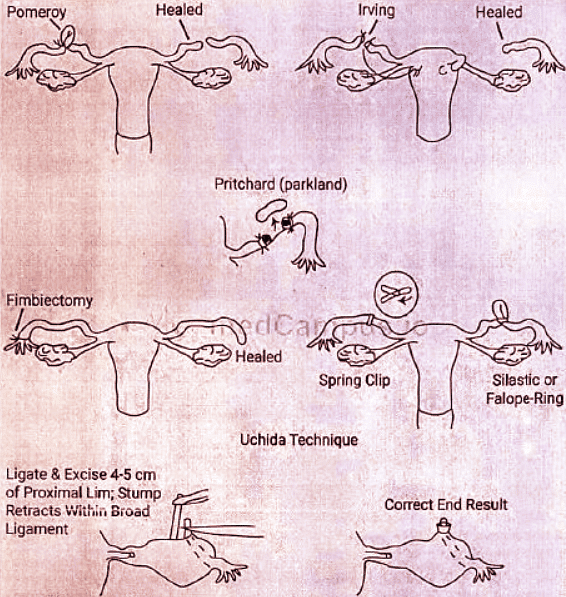 Sterilization | Medical Science Optional Notes for UPSC