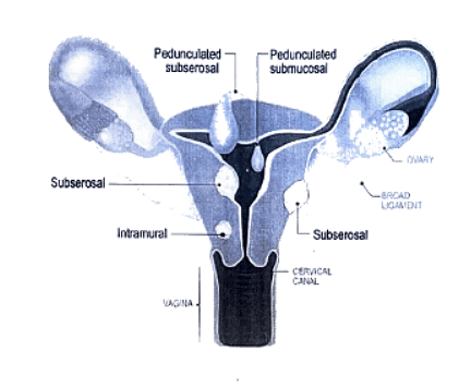 Uterine Fibroid | Medical Science Optional Notes for UPSC