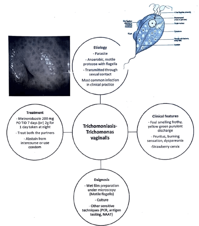 Leucorrhea and STDs | Medical Science Optional Notes for UPSC