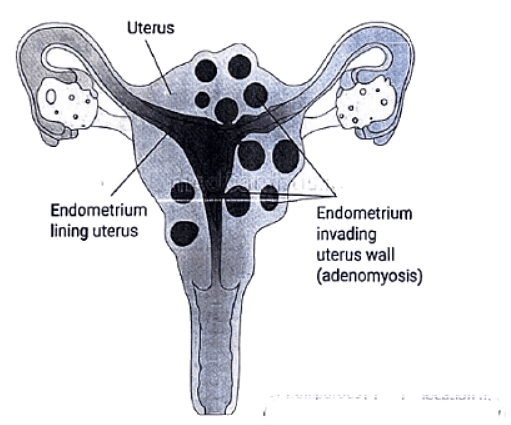 Uterine Fibroid | Medical Science Optional Notes for UPSC