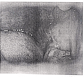 Oral Cancer | Medical Science Optional Notes for UPSC
