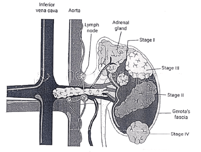 Renal Mass | Medical Science Optional Notes for UPSC