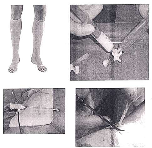 Varicose Veins | Medical Science Optional Notes for UPSC