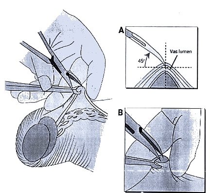 Urinary Bladder, Uterine Tubes, Vas Deferens: Clinical Anatomy | Medical Science Optional Notes for UPSC