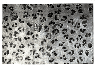 Leucorrhea and STDs | Medical Science Optional Notes for UPSC