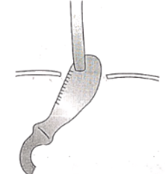 Carcinoma Esophagus | Medical Science Optional Notes for UPSC