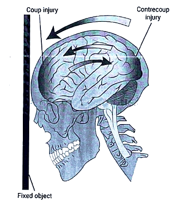 Head Injury - Medical Science Optional Notes for UPSC PDF Download