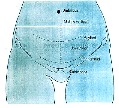 Cesarean section | Medical Science Optional Notes for UPSC