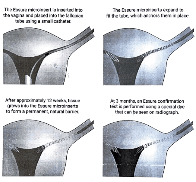 Contraception | Medical Science Optional Notes for UPSC