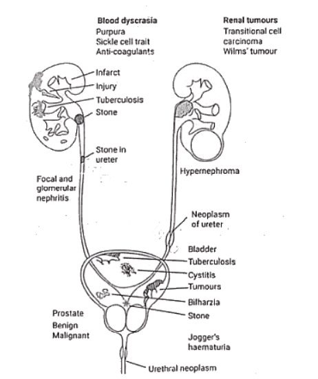 Renal Stones | Medical Science Optional Notes for UPSC
