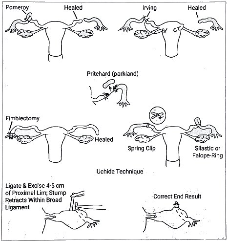 Urinary Bladder, Uterine Tubes, Vas Deferens: Clinical Anatomy | Medical Science Optional Notes for UPSC