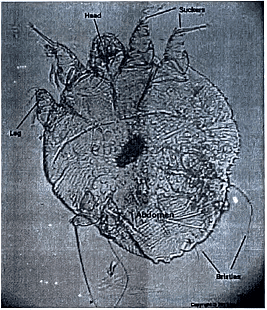 Scabies | Medical Science Optional Notes for UPSC