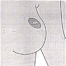 Breast | Medical Science Optional Notes for UPSC
