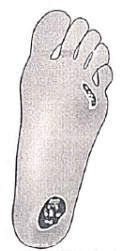 Varicose Veins | Medical Science Optional Notes for UPSC