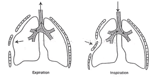 Hemothorax | Medical Science Optional Notes for UPSC
