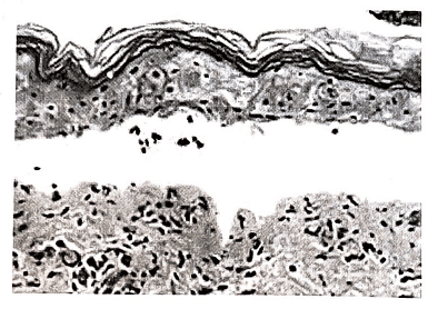 Steven Johnson syndrome (SJS) | Medical Science Optional Notes for UPSC