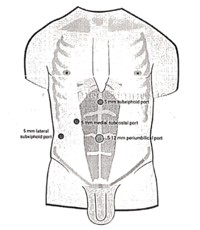 Gall Stones | Medical Science Optional Notes for UPSC