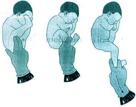 Abnormal Labour | Medical Science Optional Notes for UPSC