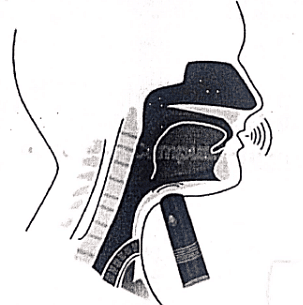 Carcinoma Larynx | Medical Science Optional Notes for UPSC