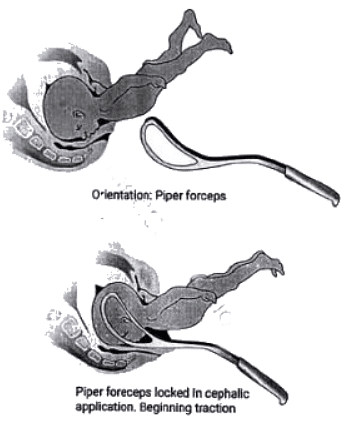 Abnormal Labour | Medical Science Optional Notes for UPSC
