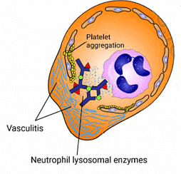 Hypersensitivity Reactions | Medical Science Optional Notes for UPSC