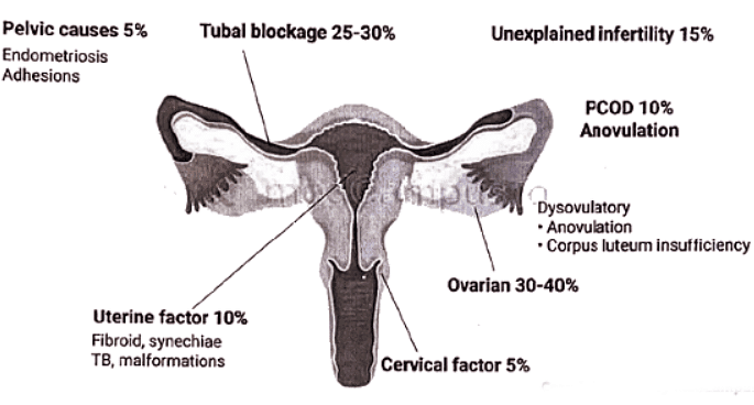 Infertility | Medical Science Optional Notes for UPSC