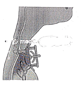 Carcinoma Larynx | Medical Science Optional Notes for UPSC