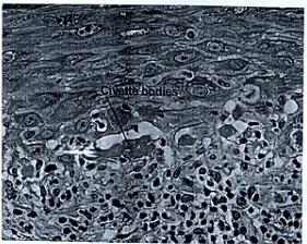 Lichen Planus | Medical Science Optional Notes for UPSC
