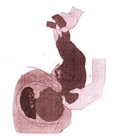 Abnormal Labour | Medical Science Optional Notes for UPSC