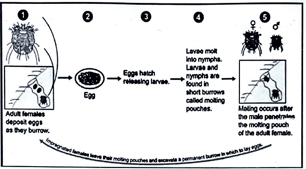 Scabies | Medical Science Optional Notes for UPSC
