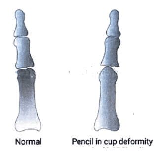 Psoriasis | Medical Science Optional Notes for UPSC