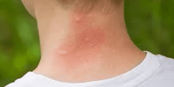 Mosquito Bite