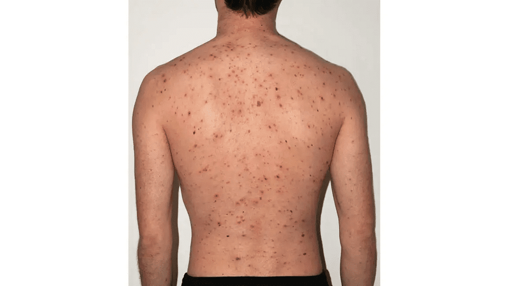 Chickenpox