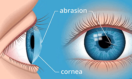 Cornea