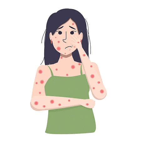 Measles
