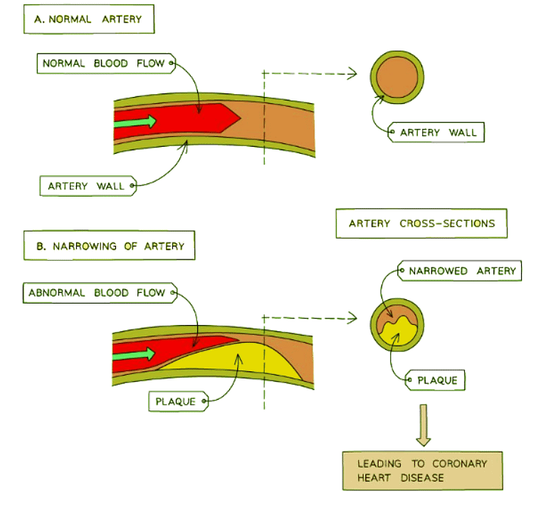 Effect of narrowing of arteries